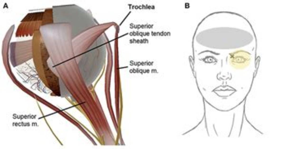 How Long Does Trochleitis Last?