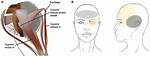 How Long Does Trochleitis Last?