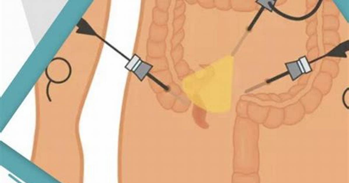 How Long Is Appendix Surgery?