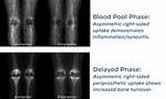 How Much Does a 3 Phase Bone Scan Cost? Check This out | 3 Phase Bone Scan Cost