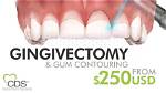 How Much Does Gingivectomy Cost?