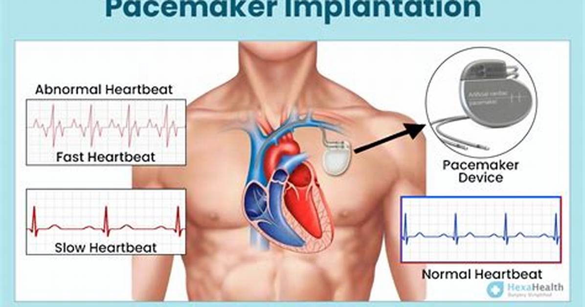 How Pacemaker Surgery Is Done?