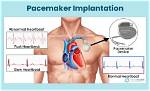 How Pacemaker Surgery Is Done?