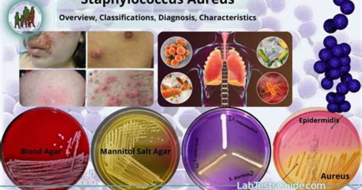 How Staphylococcus Is Treated?