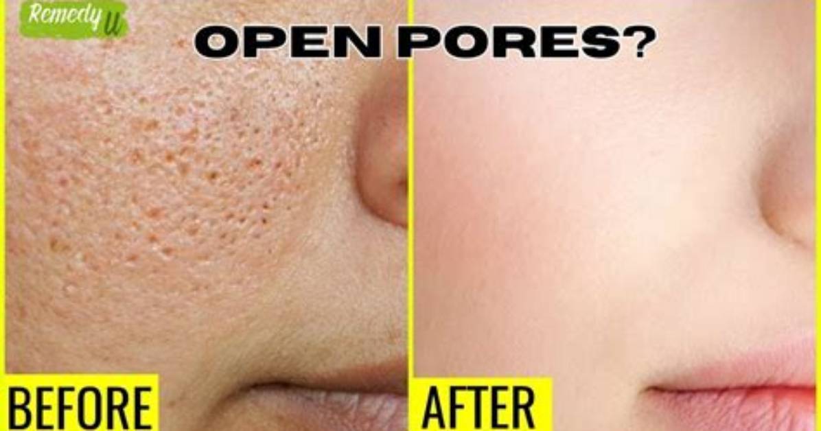 How to Close Pores?