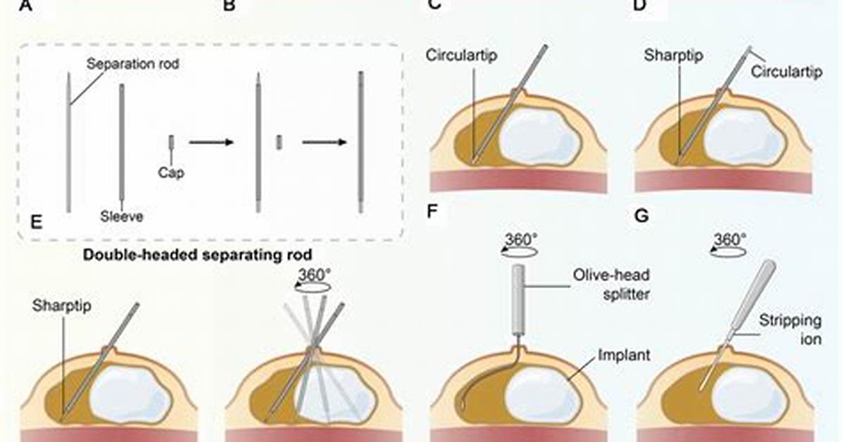 How to Code Capsulectomy?
