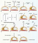 How to Code Capsulectomy?