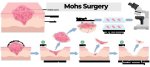 How to Code Mohs Micrographic Surgery?
