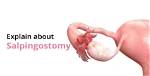 How to Code Salpingostomy?