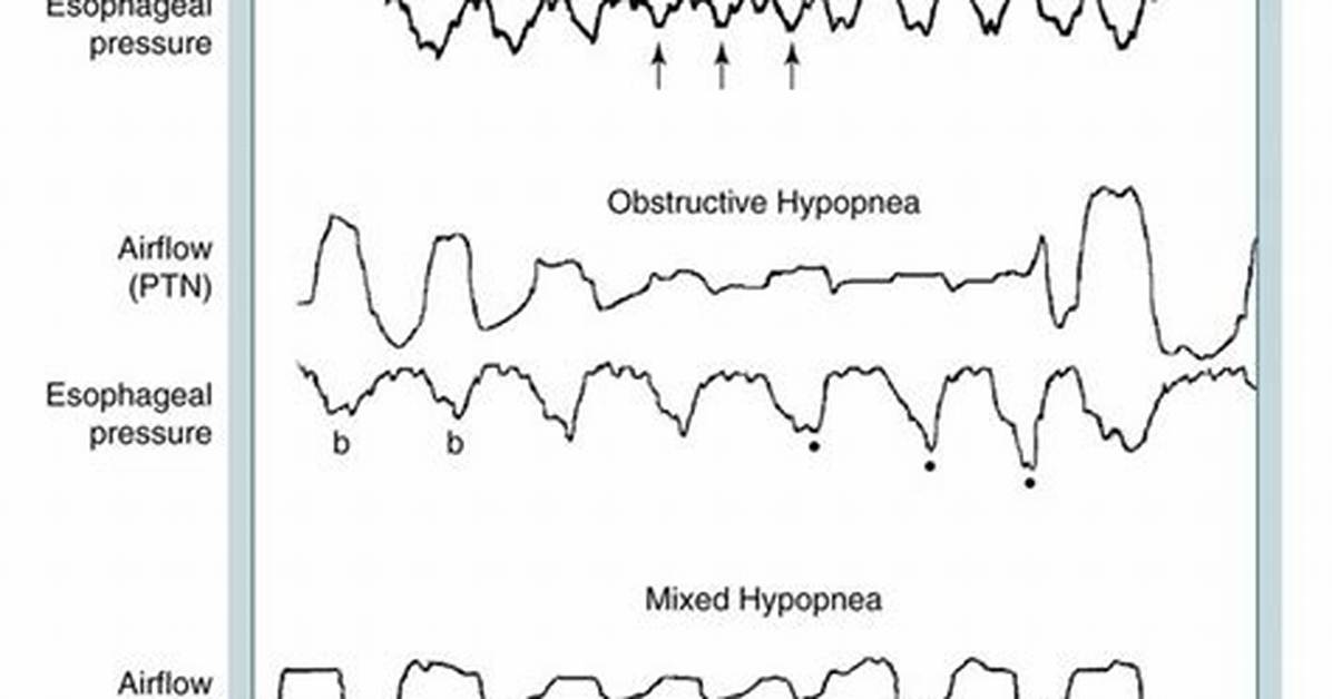 How to Decrease Hypopneas?