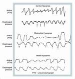 How to Decrease Hypopneas?