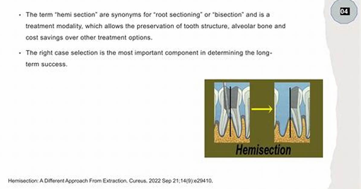 How to Define Hemisection?