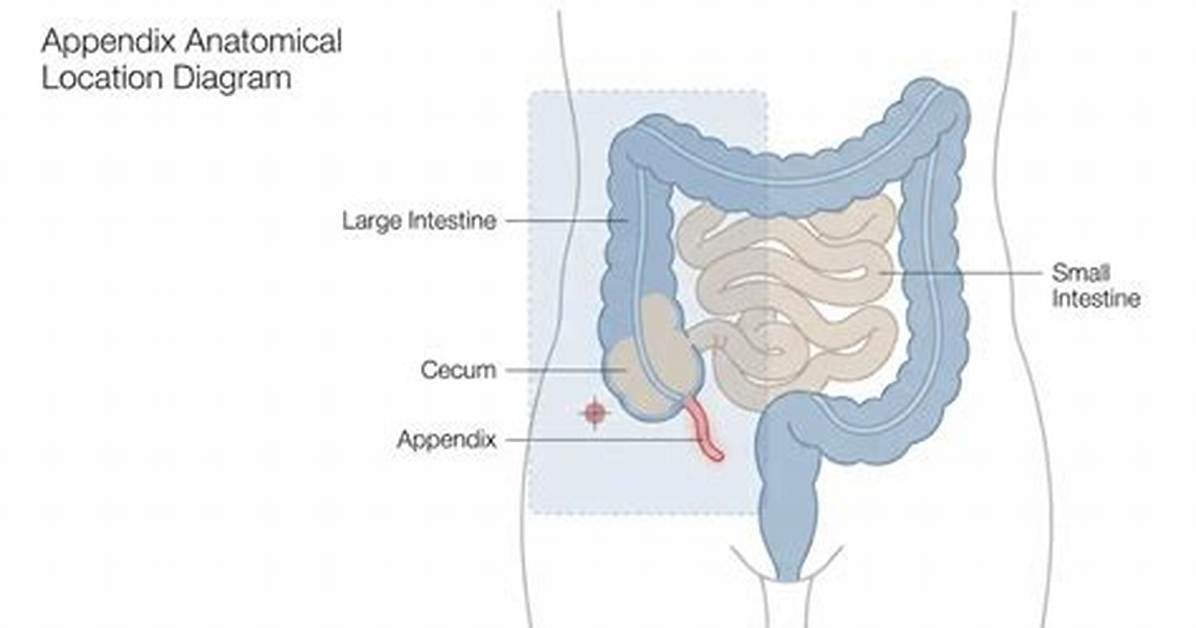 How to Do Appendectomy?