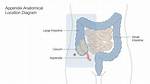 How to Do Appendectomy?