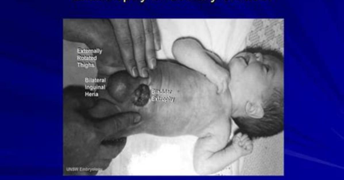 How to Fix Bladder Exstrophy?