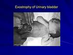 How to Fix Bladder Exstrophy?