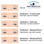How to Fix Eye Misalignment?