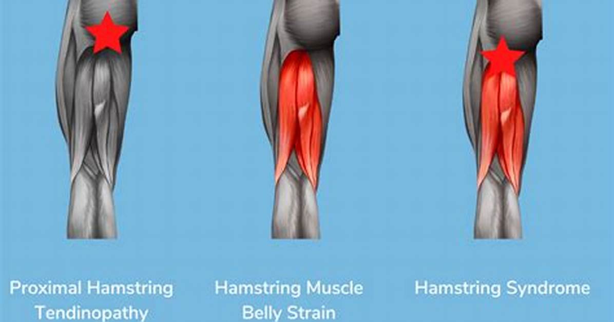 How to Fix Overstretched Hamstring?