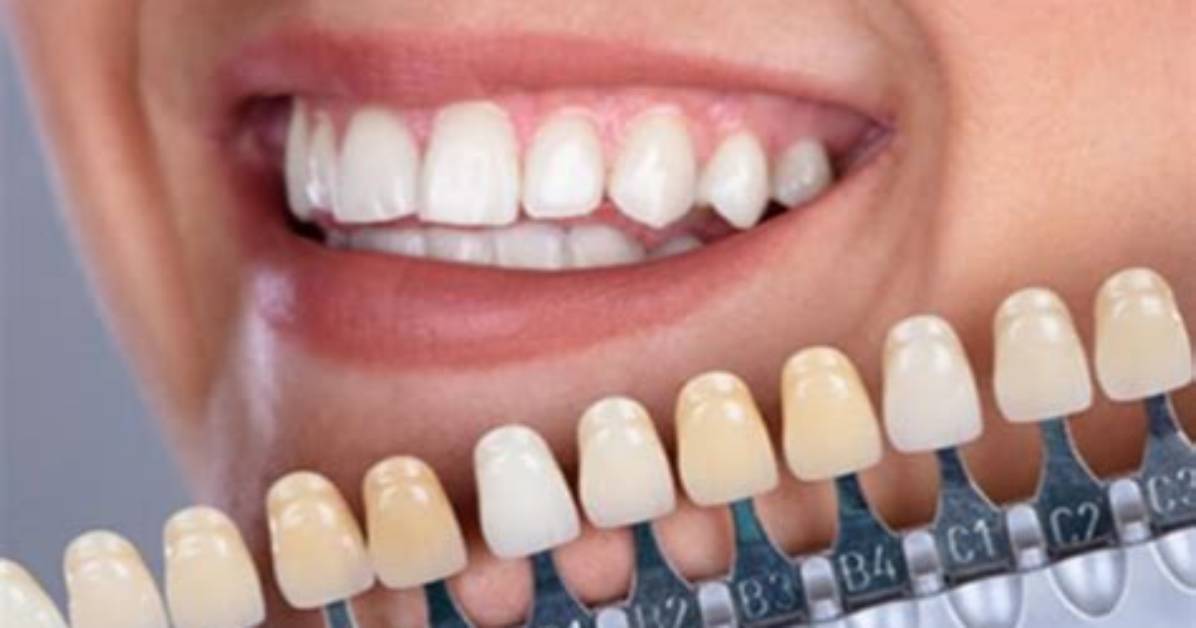 How to Fix Translucent Teeth?