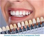 How to Fix Translucent Teeth?