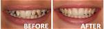 How to Fix Unaligned Teeth?