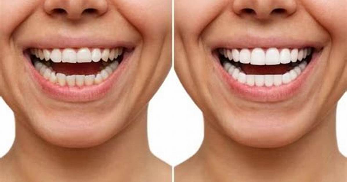 How to Get Perfect Teeth