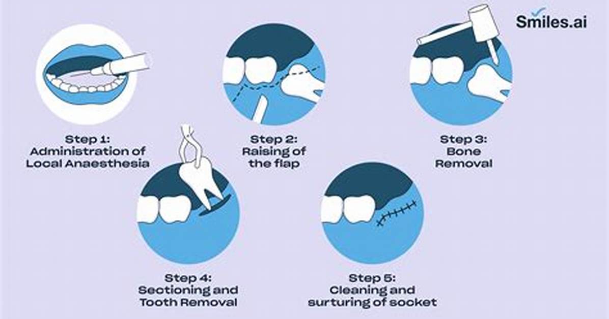 How to Remove a Teeth?