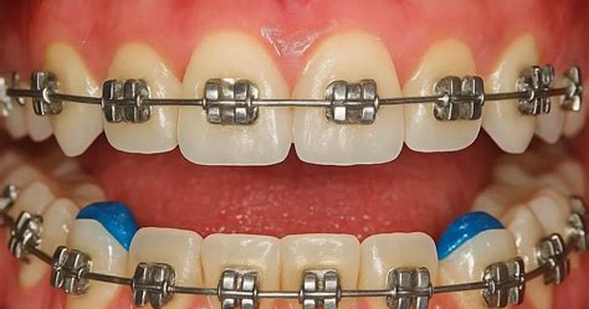How to Remove Bite Blocks Braces