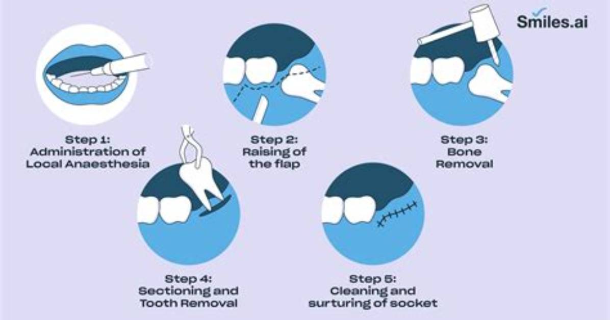 How to Remove Teeth?