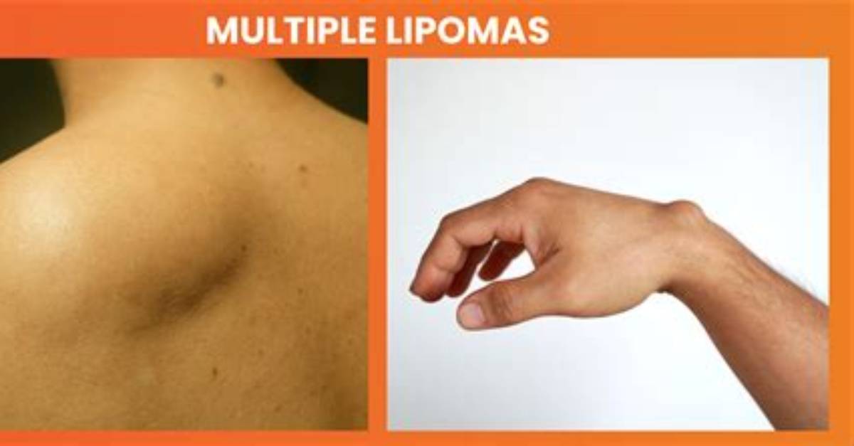 How to Reverse Lipomas?