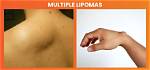 How to Reverse Lipomas?