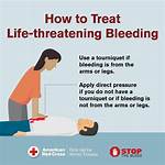 How to Stop Bleeding?