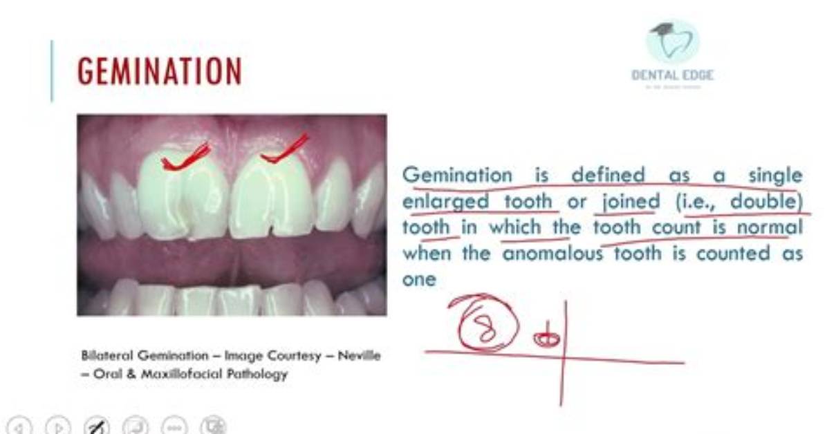 How to Write Gemination?
