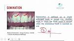 How to Write Gemination?