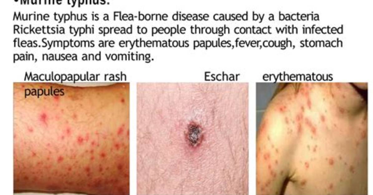 How Typhus Is Spread?
