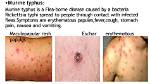 How Typhus Is Spread?