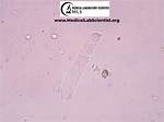 Hyaline Cast