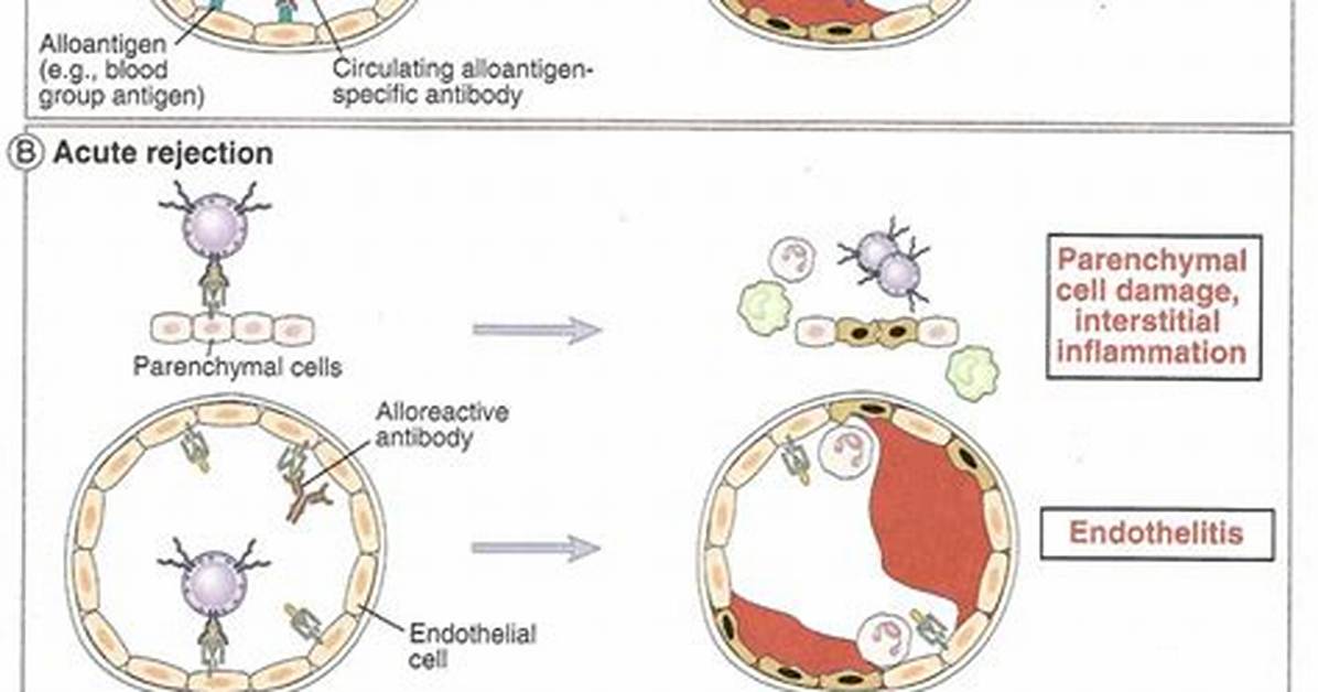 Hyperacute Rejection