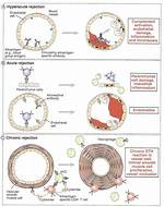 Hyperacute Rejection