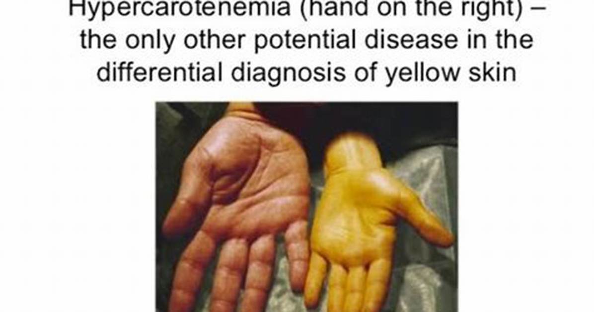 Hypercarotenemia