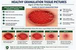 Hypergranulation