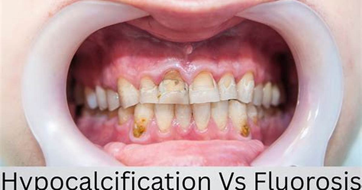 Hypocalcification