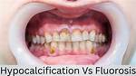 Hypocalcification