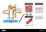 Hypotonic Dehydration