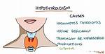 Icd 10 Hyperthyroidism