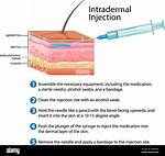 Id Injection
