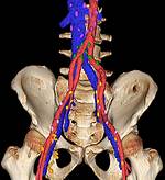Iliac Lymph Nodes