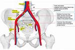 Iliac Nodes