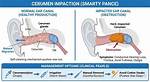 Impacted Cerumen Bilateral
