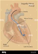 Impella Placement